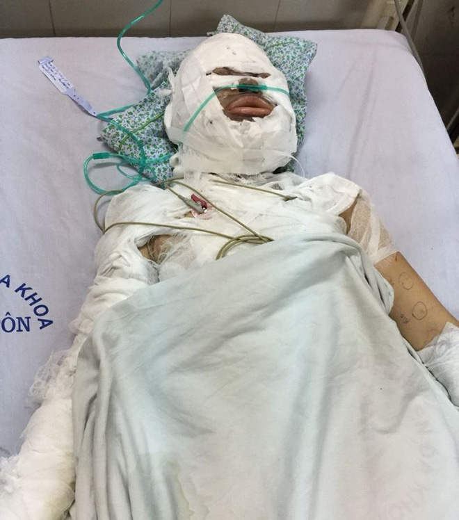 Nghi án nữ thợ may bị bạn trai ngoại quốc tưới xăng đốt