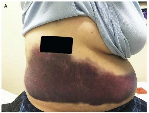 Người phụ nữ gãy xương sườn vì ho quá mạnh