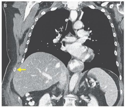 Người phụ nữ gãy xương sườn vì ho quá mạnh