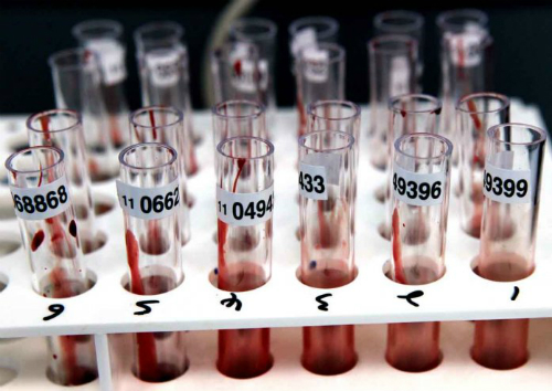 Một xét nghiệm máu có thể phát hiện tám bệnh ung thư