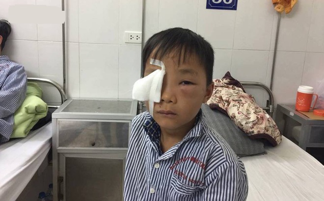 Bé trai 8 tuổi bị chó cắn thủng mắt, bố mẹ nhìn thấy nhưng không kịp trở tay Bé trai 8 tuổi bị chó cắn thủng mắt, bố mẹ nhìn thấy nhưng không kịp trở tay