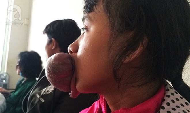 Xót lòng thiếu nữ 15 tuổi mang ngón tay trên miệng, bỏ học vì bạn bè trêu chọc