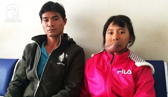 Xót lòng thiếu nữ 15 tuổi mang ngón tay trên miệng, bỏ học vì bạn bè trêu chọc