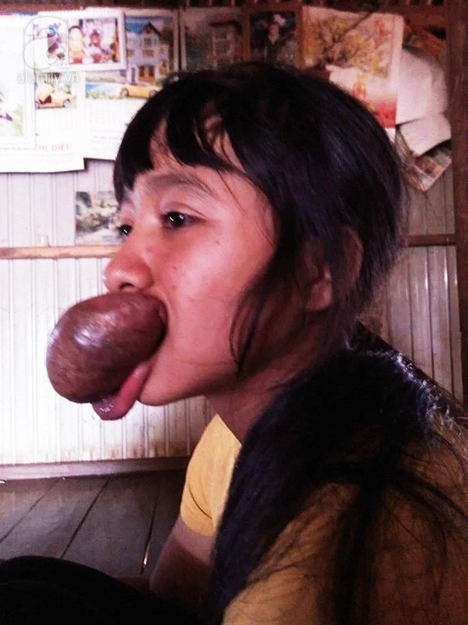 Xót lòng thiếu nữ 15 tuổi mang ngón tay trên miệng, bỏ học vì bạn bè trêu chọc