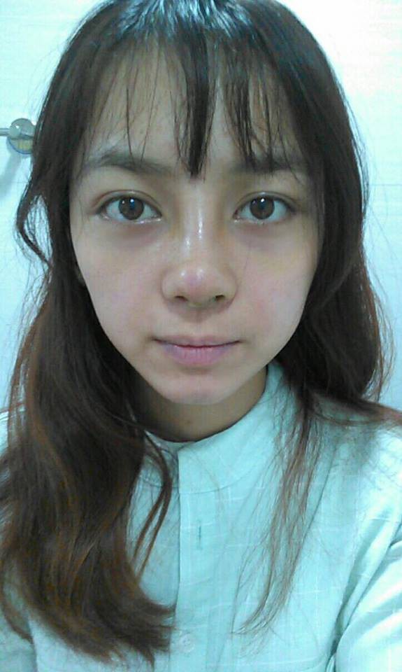 Trải nghiệm kinh hoàng của cô gái trẻ lần đầu nâng mũi sẽ khiến nhiều người nghĩ lại nếu định dao kéo