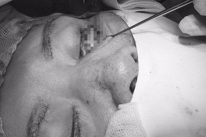 Đua nhau đi làm đẹp đón Tết với giá rẻ, nhiều chị em thủng mũi, biến dạng mí mắt, lõm má