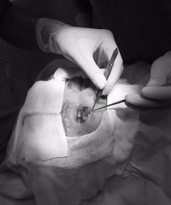 Đua nhau đi làm đẹp đón Tết với giá rẻ, nhiều chị em thủng mũi, biến dạng mí mắt, lõm má