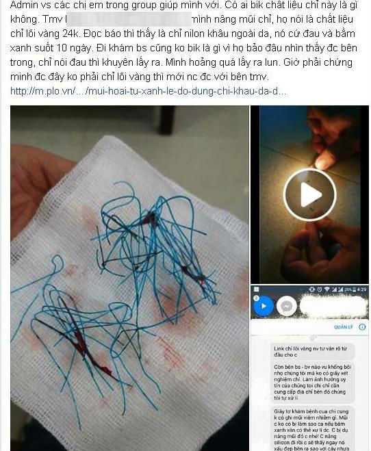 Thực hiện nâng mũi bằng chỉ vàng 24k thiếu nữ nhận cái kết đắng