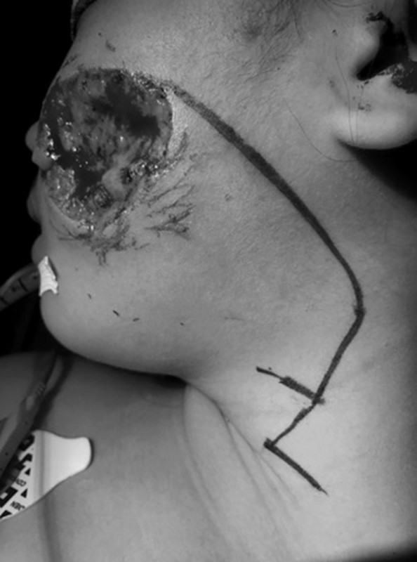 Chơi đùa với chó, bé gái 8 tuổi bị cắn biến dạng mặt