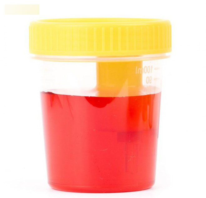 Khi xuất hiện 4 dấu hiệu này hãy coi chừng trong cơ thể bạn đã có tế bào ung thư