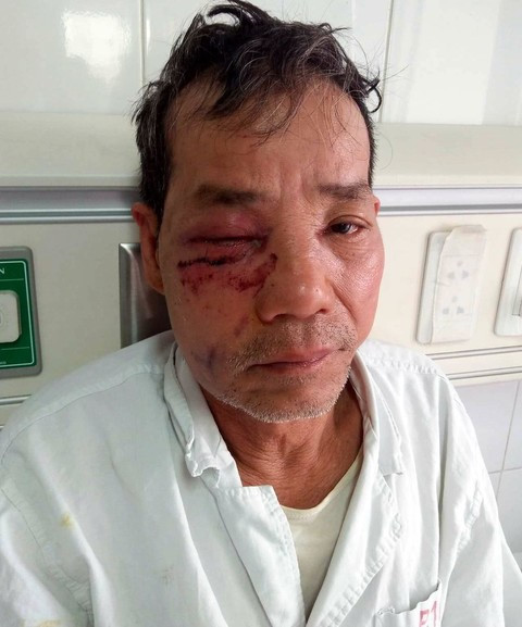 Lâm tặc phục kích ném đá cán bộ kiểm lâm trọng thương