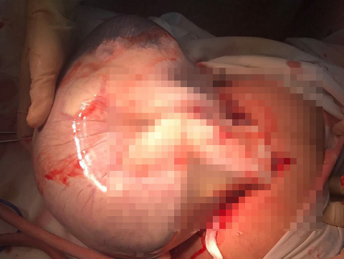 Kỳ diệu sản phụ sinh đôi, 1 bé gái còn nguyên trong bọc ối