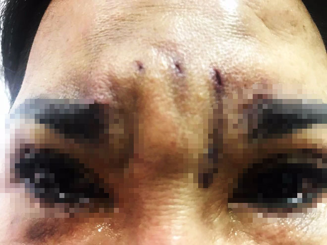 TP.HCM: Đi treo chân mày bằng chỉ để bớt già, người phụ nữ bị biến dạng mắt