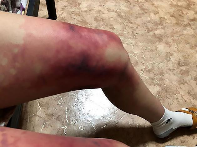 Cô gái nhập viện vì diện váy ngắn trong thời tiết âm 40 độ