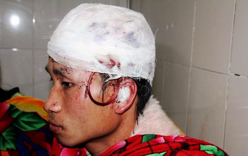 Vào rừng lấy lá dong, một nam thanh niên bị gấu tấn công