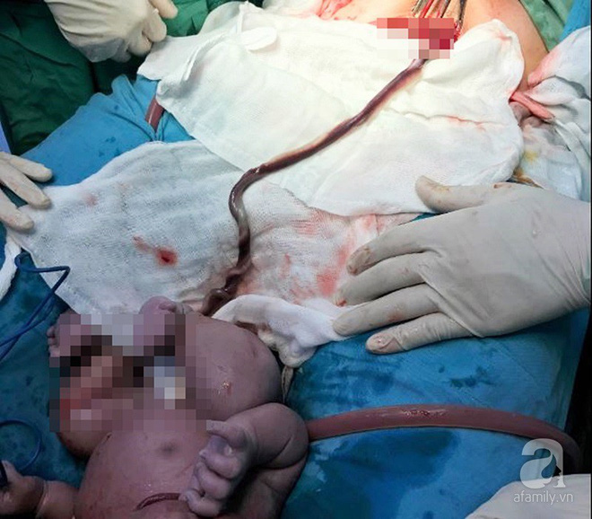 Cần Thơ: Sản phụ 29 tuổi suýt mất con vì tình trạng tắc mạch rốn trong tử cung rất hiếm gặp