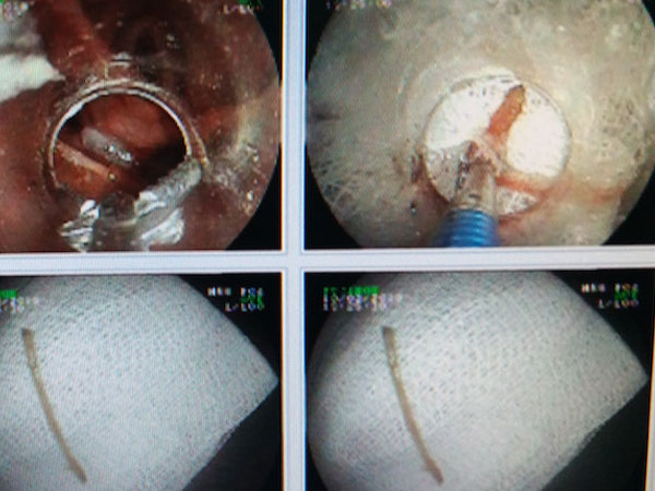 Suýt mất mạng vì hóc xương vịt dài 4 cm