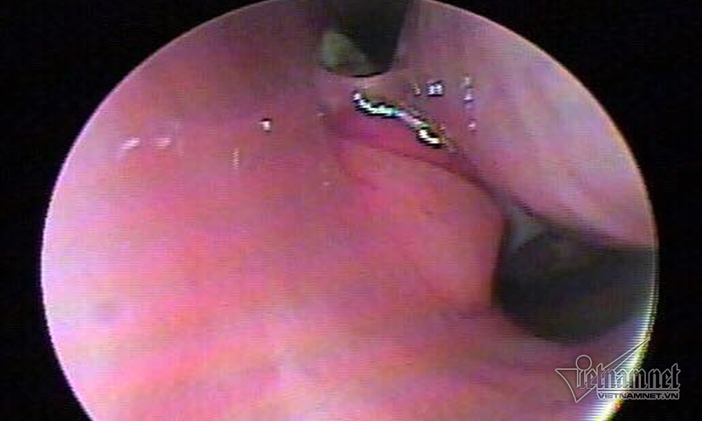 Kỳ lạ nữ sinh mọc răng ở lỗ mũi