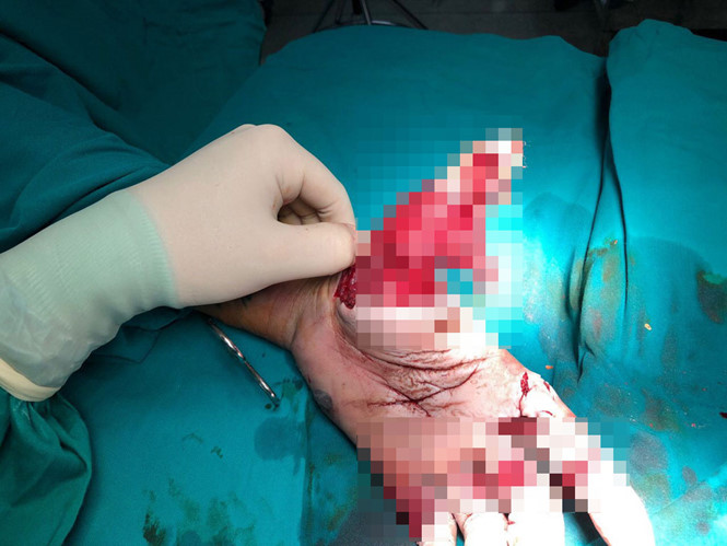 Nhậu say rồi đốt pháo, chàng trại bị dập nát bàn tay