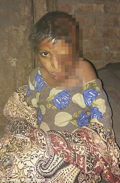 Khuôn mặt bị hủy hoại kinh hoàng và tội ác trời không dung của người cha