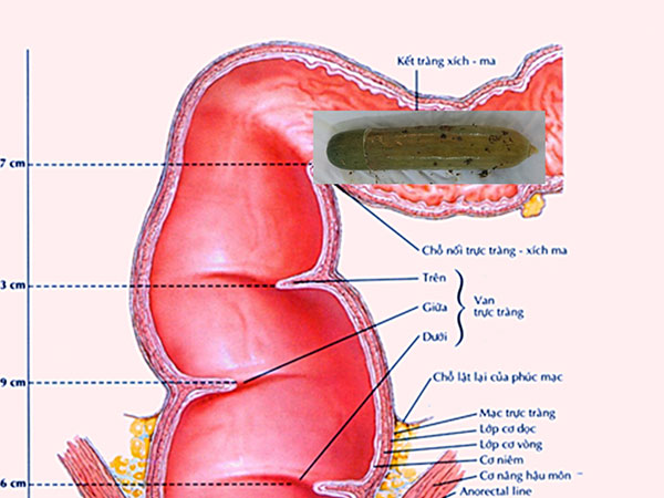 Một bác sĩ phải cấp cứu vì lọt cả quả dưa leo vào bụng