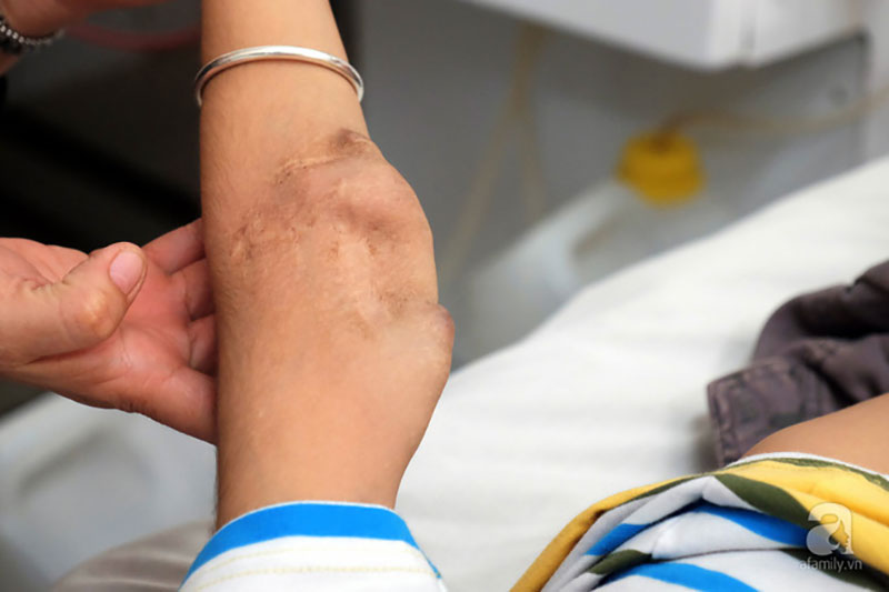 Tết trong bệnh viện của những đứa trẻ chạy thận: Tay sưng vù vì vết kim châm