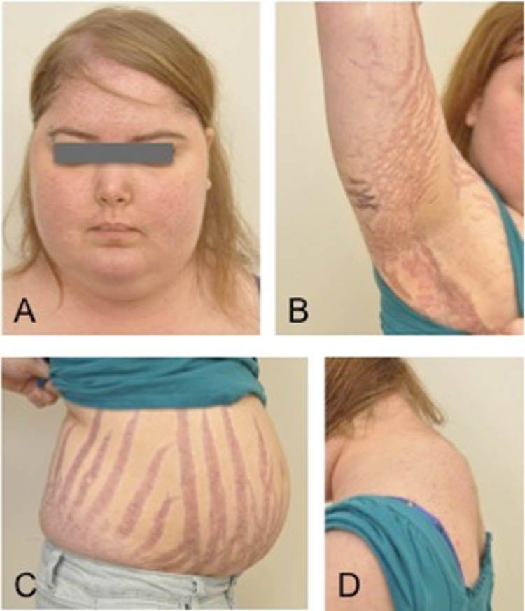 Bé gái 7 tuổi mọc râu, lông khắp người vì thuốc chữa biếng ăn