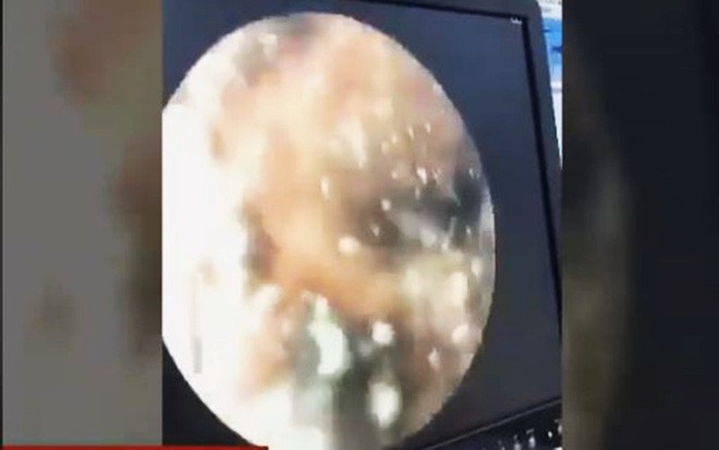 Long An: Bé gái 4 tháng tuổi bị giòi làm tổ, ăn chảy máu lỗ tai