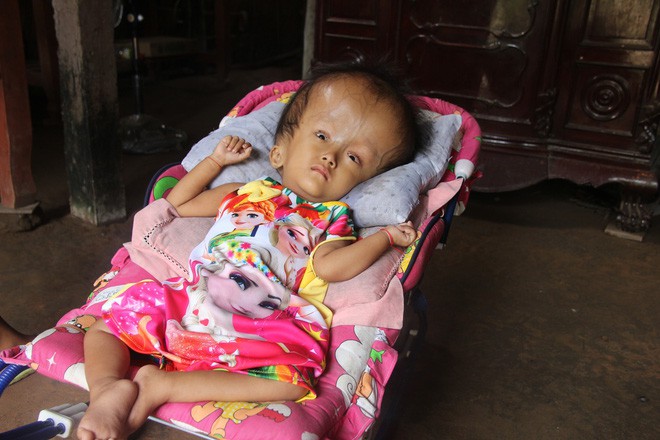 Phép màu kỳ diệu đến với cặp vợ chồng trẻ nuôi con gái 4 tuổi bị não úng thủy, đầu to gấp 3 lần trong năm mới