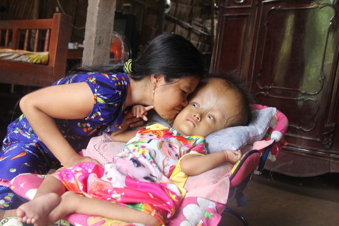 Phép màu kỳ diệu đến với cặp vợ chồng trẻ nuôi con gái 4 tuổi bị não úng thủy, đầu to gấp 3 lần trong năm mới