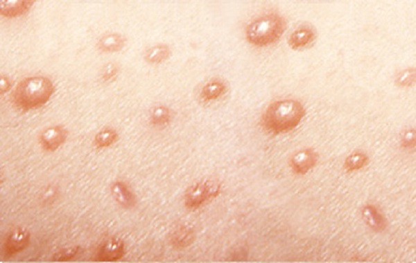 Đây chính là những dịch bệnh rất dễ bùng phát khi thời tiết nồm ẩm và cách phòng tránh