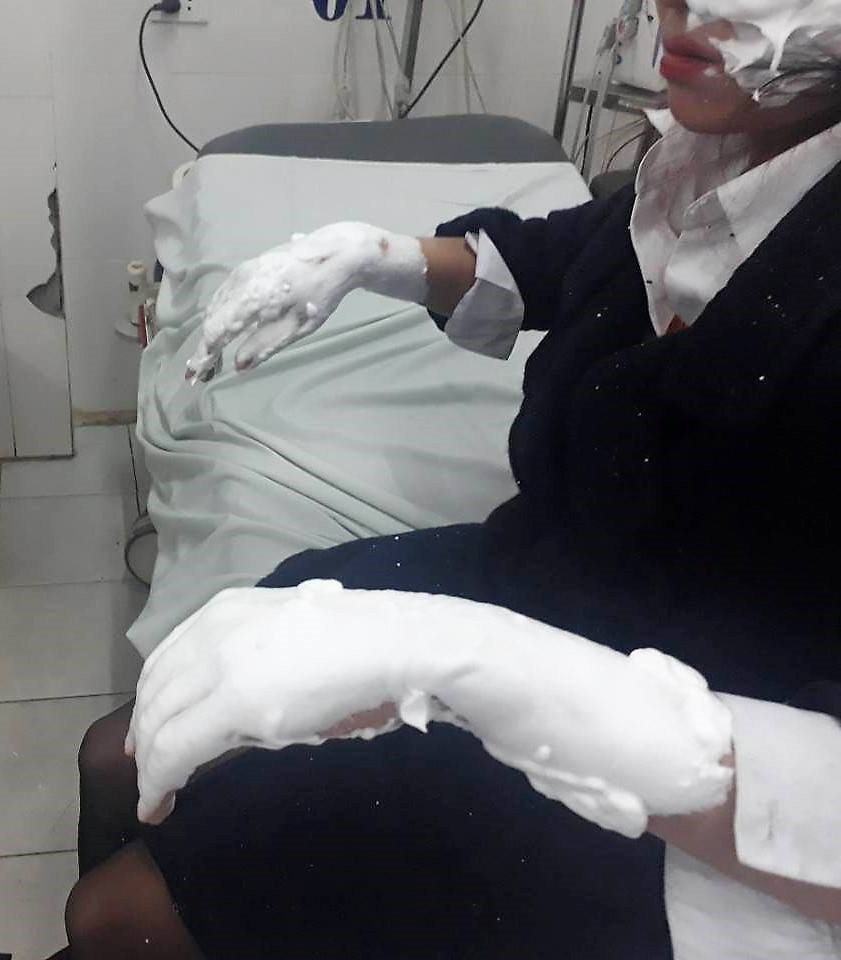 Bóng bay galaxy phát nổ, 3 sinh viên bị bỏng nặng