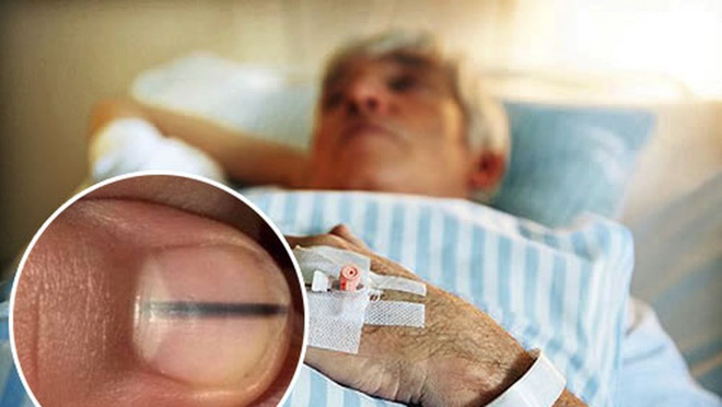 Cảnh giác ngay khi thấy trên móng tay có dấu hiệu bất thường này