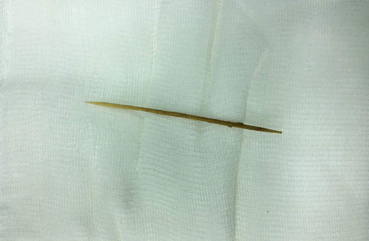 Suýt chết vì nuốt tăm xỉa răng nhưng không nhớ