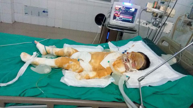 Thái Bình: Chập điện cháy nhà giữa đêm, vợ chồng bỏng nặng, bé gái 4 tuổi nguy kịch