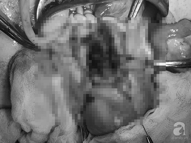 Thai lần 3 bám vào sẹo mổ cũ biến chứng, người phụ nữ 39 tuổi ở Cần Thơ suýt chết