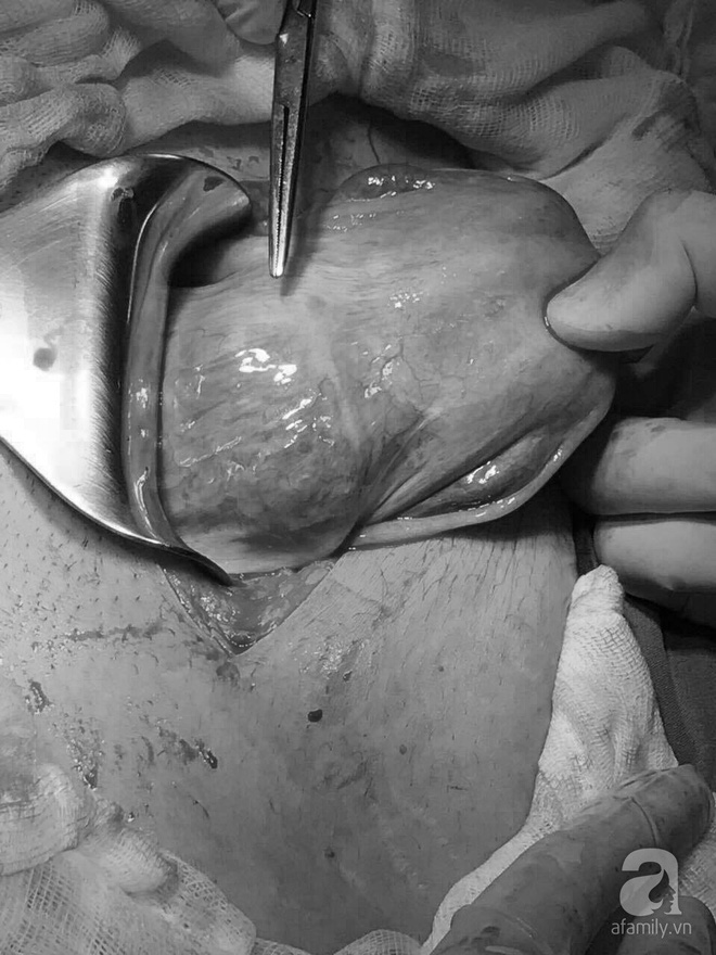 Thai lần 3 bám vào sẹo mổ cũ biến chứng, người phụ nữ 39 tuổi ở Cần Thơ suýt chết