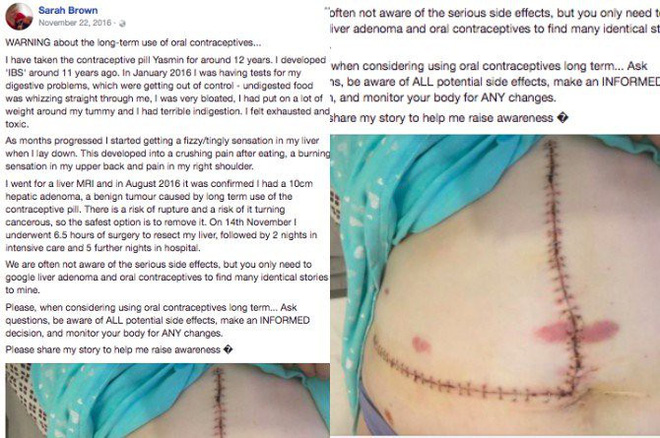 Nếu đang dùng thuốc tránh thai thường xuyên chị em cần cẩn trọng vì có thể mắc 2 chứng bệnh nguy hiểm này