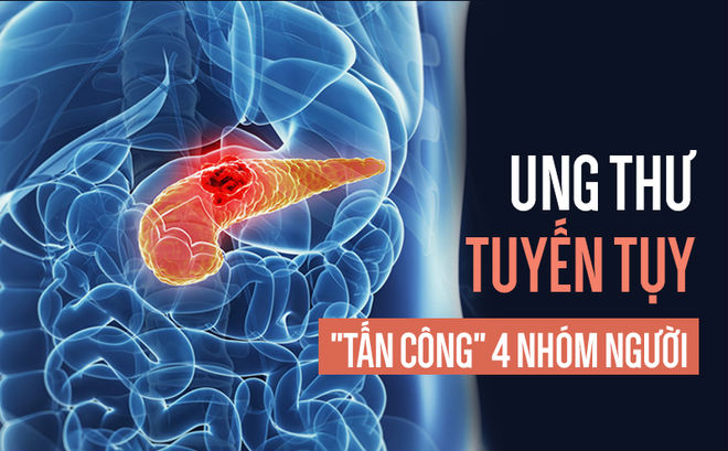 Ung thư tụy rất nguy hiểm vì khó chữa, ai có 4 đặc điểm này hãy đặc biệt cẩn thận Ung thư tụy rất nguy hiểm vì khó chữa, ai có 4 đặc điểm này hãy đặc biệt cẩn thận
