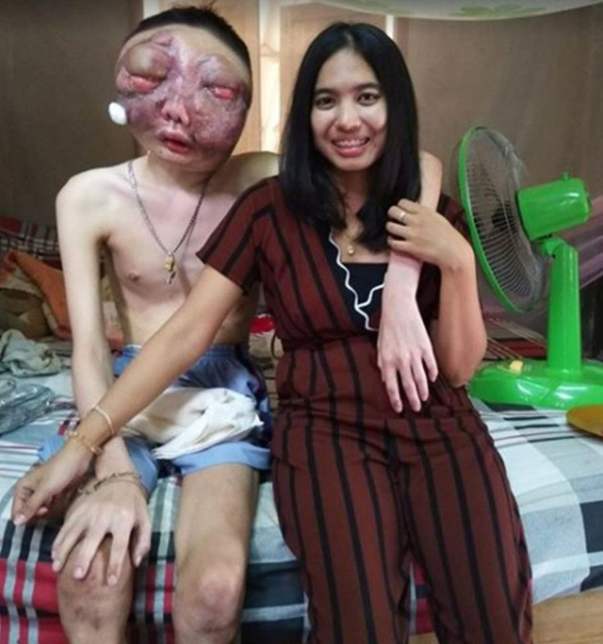 Dù chồng bị ung thư với khuôn mặt biến dạng, vợ vẫn một lòng ở bên chăm sóc: 3 năm, em vẫn yêu anh như ngày đầu