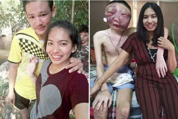 Dù chồng bị ung thư với khuôn mặt biến dạng, vợ vẫn một lòng ở bên chăm sóc: 3 năm, em vẫn yêu anh như ngày đầu