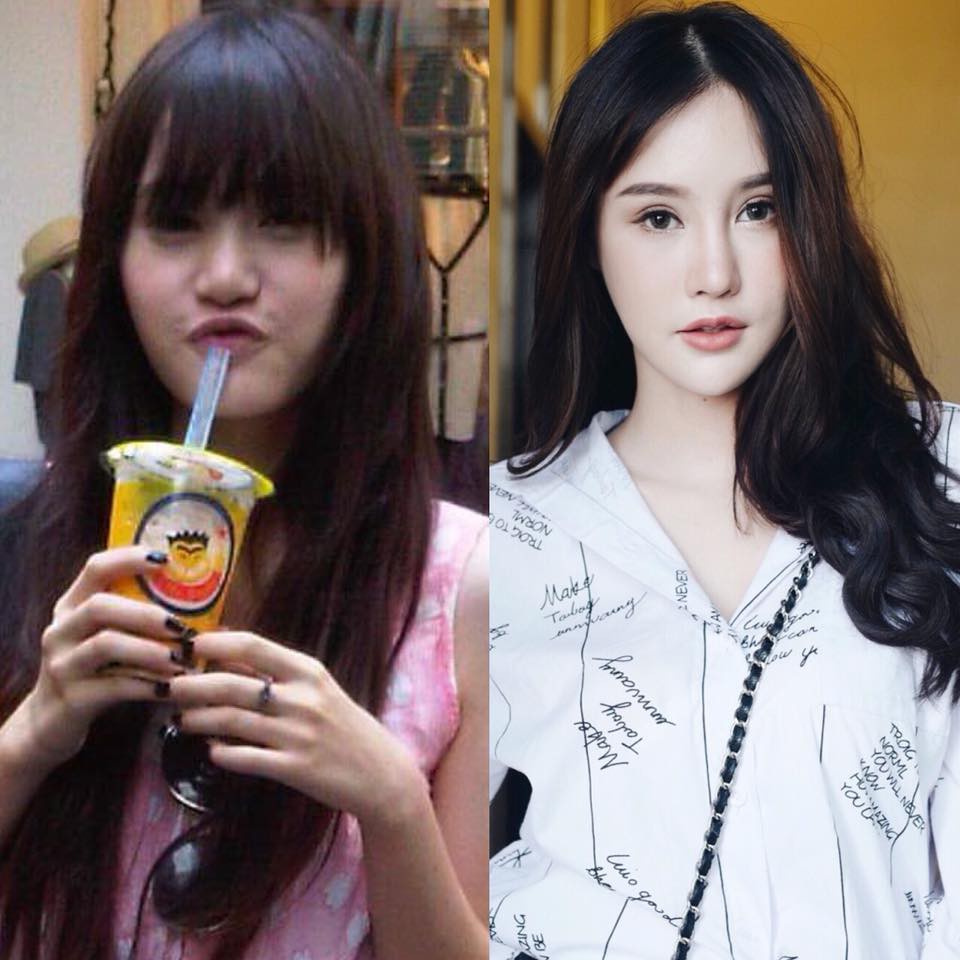 Hot Facebooker Thái Lan bật mí quá trình phẫu thuật thẩm mỹ đau đớn nhưng trả về kết quả đẹp xuất sắc