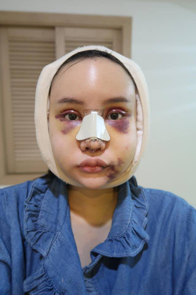 Hot Facebooker Thái Lan bật mí quá trình phẫu thuật thẩm mỹ đau đớn nhưng trả về kết quả đẹp xuất sắc Hot Facebooker Thái Lan bật mí quá trình phẫu thuật thẩm mỹ đau đớn nhưng trả về kết quả đẹp xuất sắc