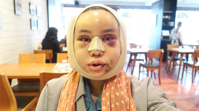 Hot Facebooker Thái Lan bật mí quá trình phẫu thuật thẩm mỹ đau đớn nhưng trả về kết quả đẹp xuất sắc