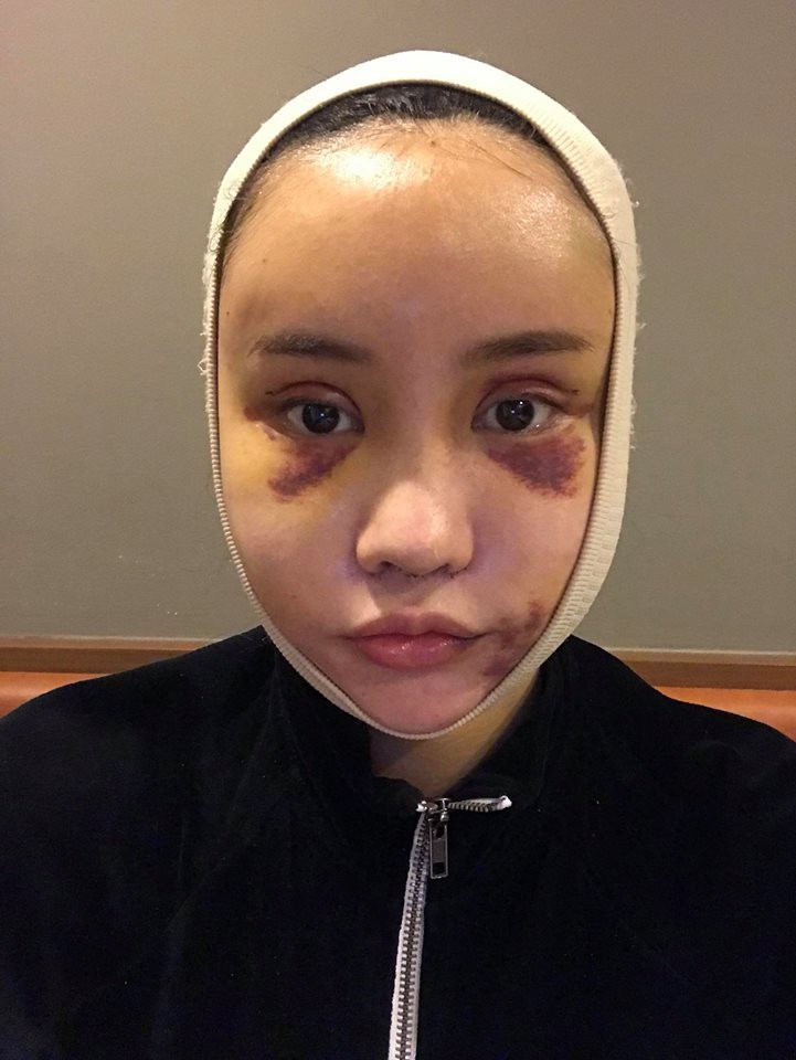 Hot Facebooker Thái Lan bật mí quá trình phẫu thuật thẩm mỹ đau đớn nhưng trả về kết quả đẹp xuất sắc