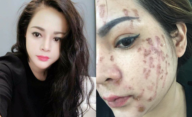 Nghe lời nhân viên spa chấm nám cho đẹp da, cô gái trẻ bị thui cháy loang lổ cả mặt