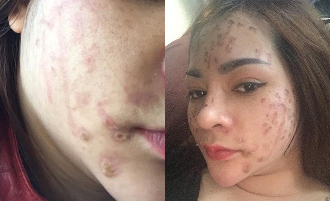 Nghe lời nhân viên spa chấm nám cho đẹp da, cô gái trẻ bị thui cháy loang lổ cả mặt