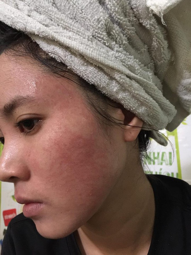 Nghe lời nhân viên spa chấm nám cho đẹp da, cô gái trẻ bị thui cháy loang lổ cả mặt