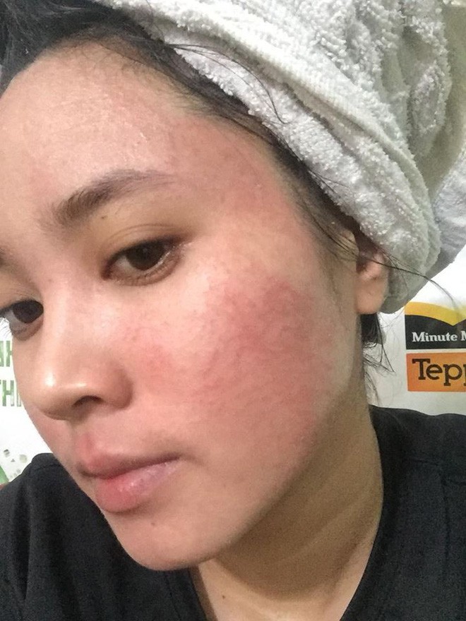 Nghe lời nhân viên spa chấm nám cho đẹp da, cô gái trẻ bị thui cháy loang lổ cả mặt Nghe lời nhân viên spa chấm nám cho đẹp da, cô gái trẻ bị thui cháy loang lổ cả mặt