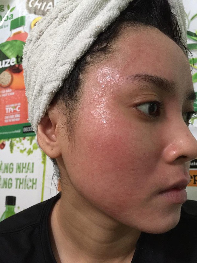 Nghe lời nhân viên spa chấm nám cho đẹp da, cô gái trẻ bị thui cháy loang lổ cả mặt Nghe lời nhân viên spa chấm nám cho đẹp da, cô gái trẻ bị thui cháy loang lổ cả mặt